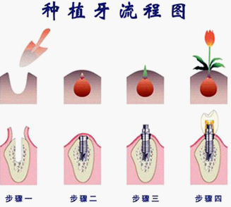 松鼠口腔种植牙流程图