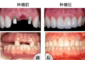 中山松鼠口腔种植牙案例