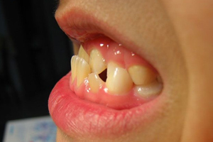 什么是地包天,地包天怎么矫正?