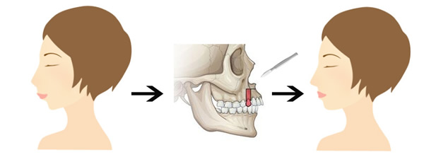 什么是龅牙?怎么矫正?