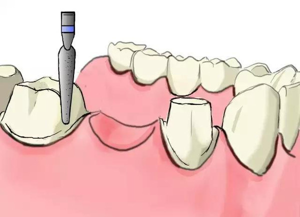 传统镶牙和种植牙的区别