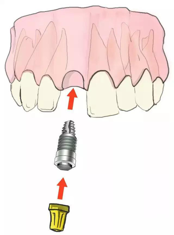 传统镶牙和种植牙的区别