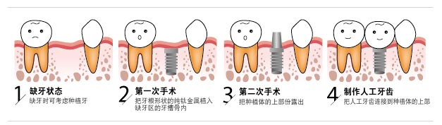 做种植牙冬天比较合适？