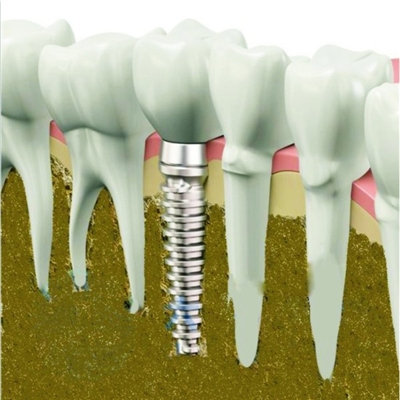 即刻种植牙