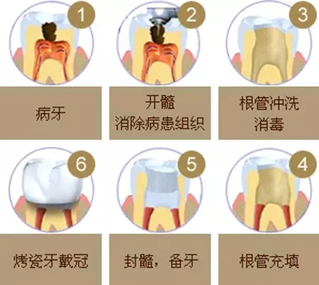 根管治疗中的常见问题