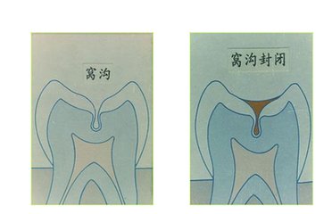 儿童较有效的防龋方法——窝沟封闭