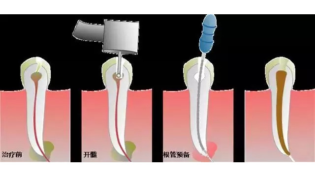 根管治疗中的常见问题